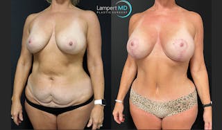 Tummy Tuck Before & After Gallery - Patient 123087301 - Image 3
