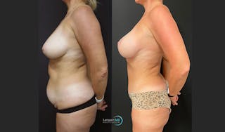 Tummy Tuck Before & After Gallery - Patient 123087301 - Image 4