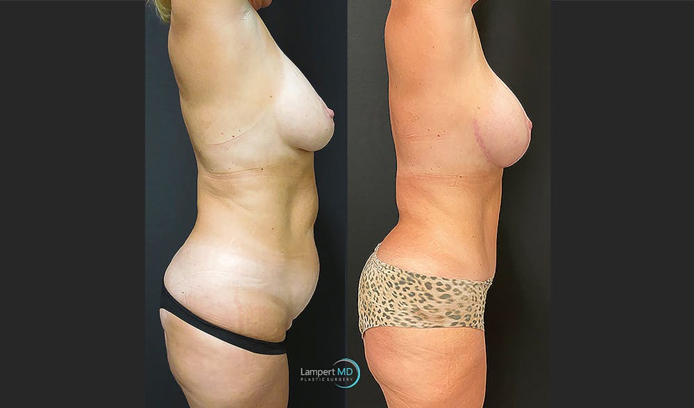 Tummy Tuck Before & After Gallery - Patient 123087301 - Image 5