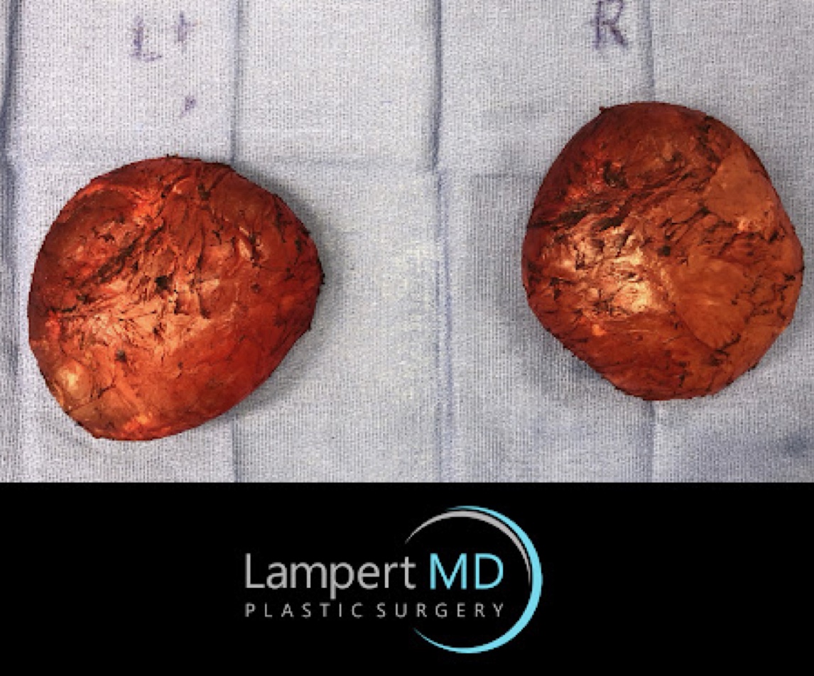Two capsulized breast implants 