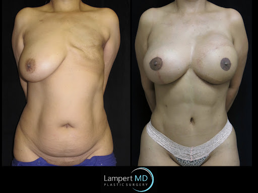 Lampert MD patient after breast reconstruction surgery