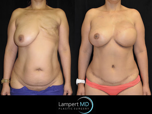 Lampert MD patient after breast reconstruction surgery