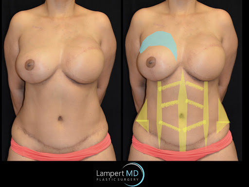 Lampert MD patient after breast reconstruction surgery