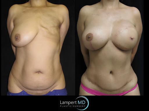 Lampert MD patient after breast reconstruction surgery