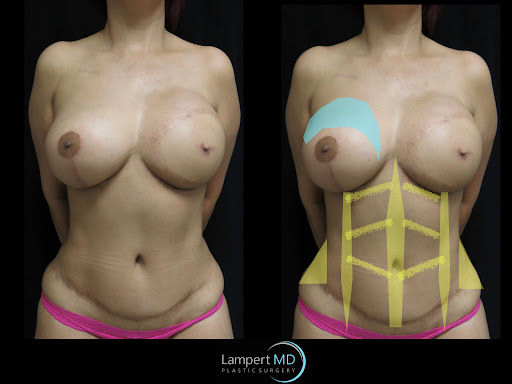 Lampert MD patient after breast reconstruction surgery