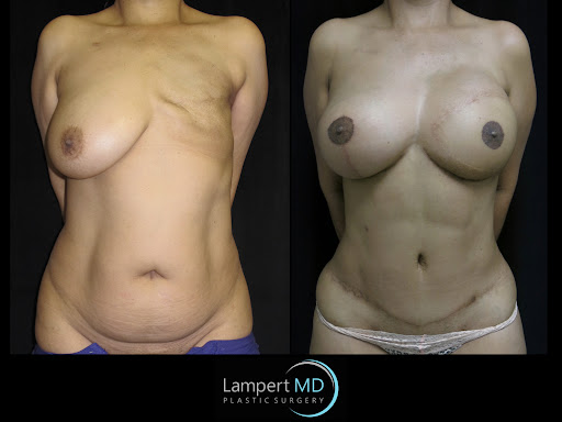 Lampert MD patient after breast reconstruction and tummy tuck surgery 