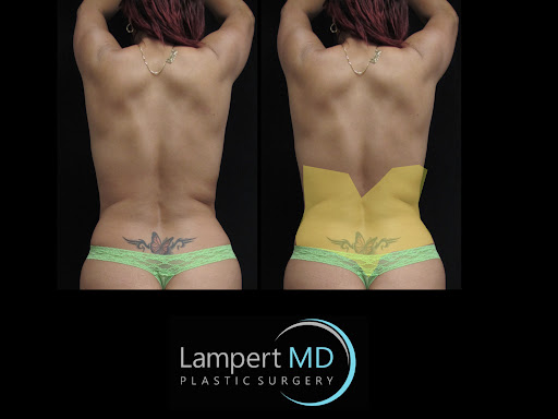 Lampert MD patient displaying areas where fat will be harvested for reconstruction surgery