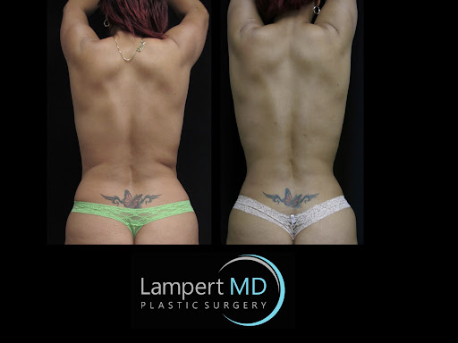 Lampert MD patient showing where fat will be harvested for reconstruction surgery