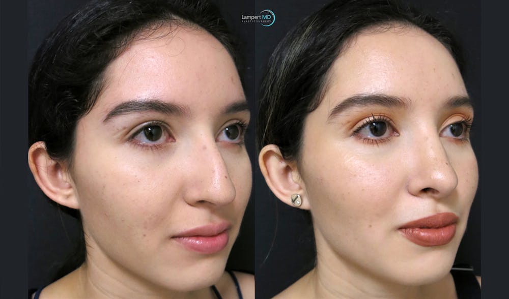 Rhinoplasty Before & After Gallery - Patient 123815963 - Image 1