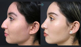 Rhinoplasty Before & After Gallery - Patient 123815963 - Image 2