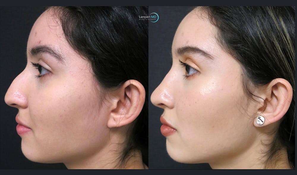 Rhinoplasty Before & After Gallery - Patient 123815963 - Image 2