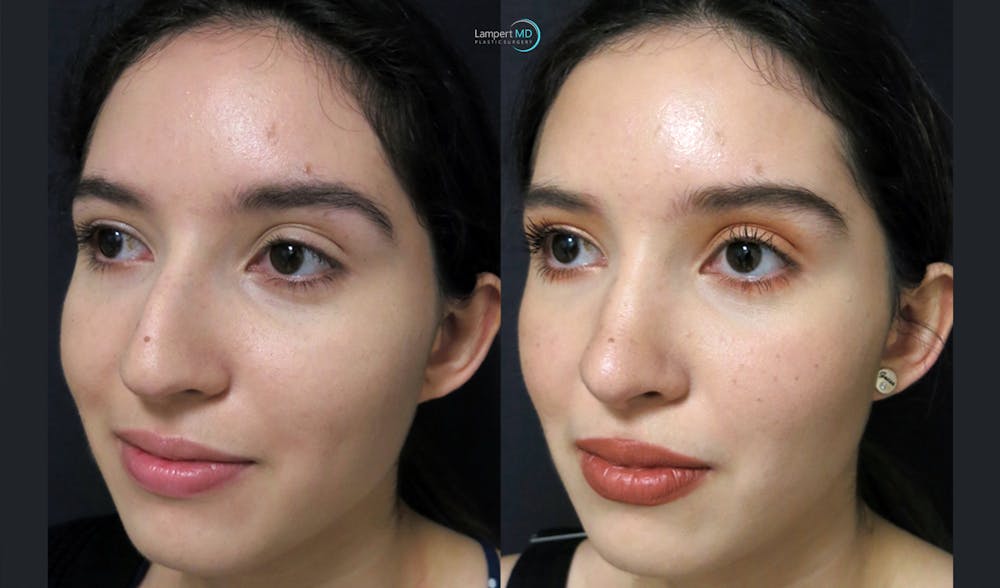 Rhinoplasty Before & After Gallery - Patient 123815963 - Image 4
