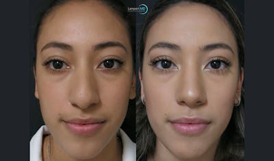 Rhinoplasty Before & After Gallery - Patient 123815980 - Image 1
