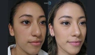 Rhinoplasty Before & After Gallery - Patient 123815980 - Image 2