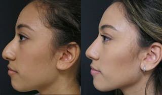 Rhinoplasty Before & After Gallery - Patient 123815980 - Image 3