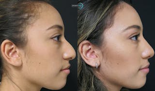 Rhinoplasty Before & After Gallery - Patient 123815980 - Image 5