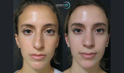 Rhinoplasty Before & After Gallery - Patient 123815997 - Image 1