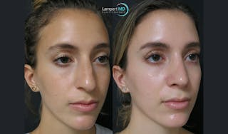 Rhinoplasty Before & After Gallery - Patient 123815997 - Image 2