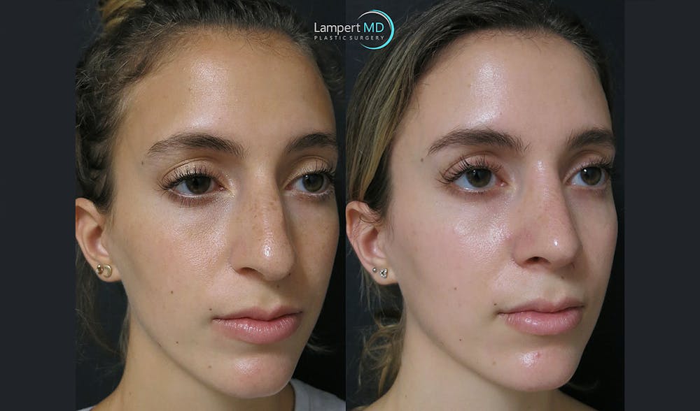 Rhinoplasty Before & After Gallery - Patient 123815997 - Image 2