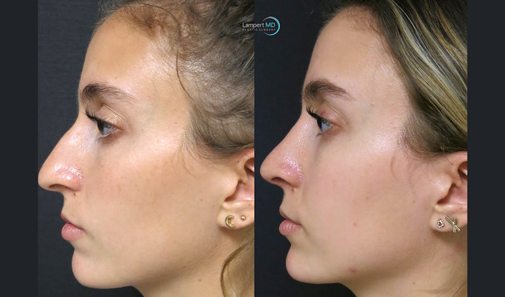 Rhinoplasty Before & After Gallery - Patient 123815997 - Image 3