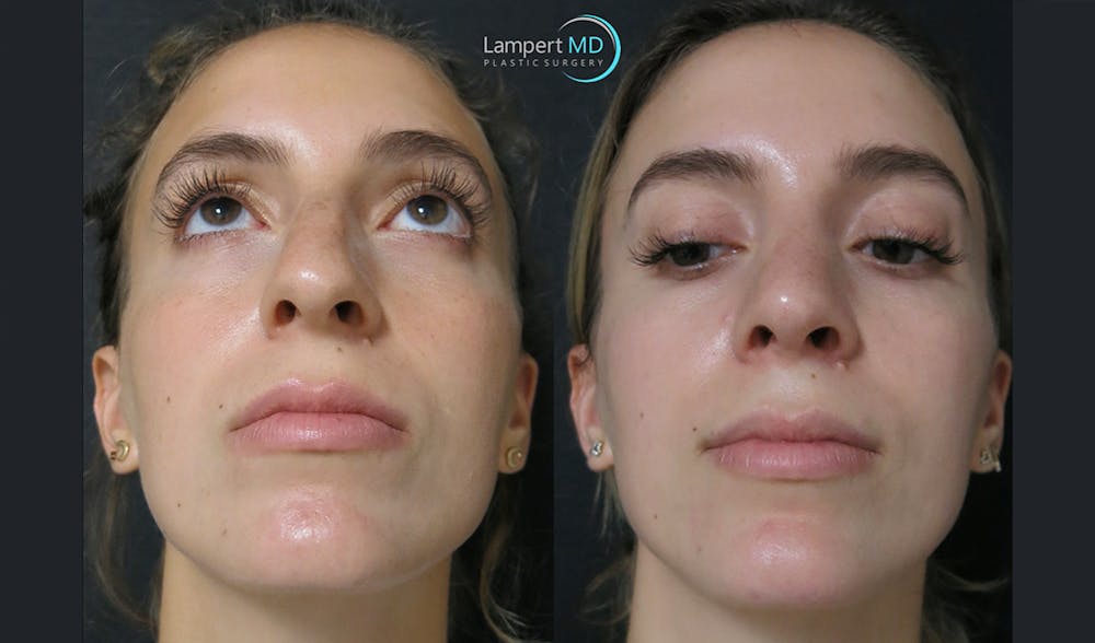 Rhinoplasty Before & After Gallery - Patient 123815997 - Image 4