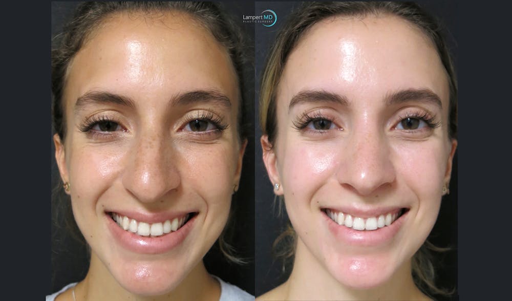 Rhinoplasty Before & After Gallery - Patient 123815997 - Image 5