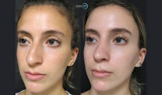 Rhinoplasty Before & After Gallery - Patient 123815997 - Image 6