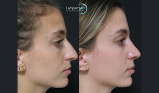 Rhinoplasty Before & After Gallery - Patient 123815997 - Image 7