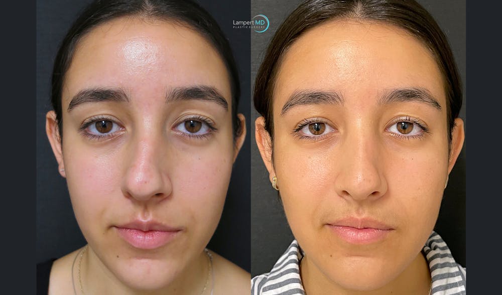 Rhinoplasty Before & After Gallery - Patient 123815998 - Image 1