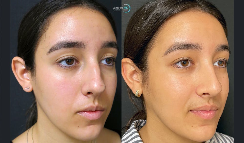 Rhinoplasty Before & After Gallery - Patient 123815998 - Image 4