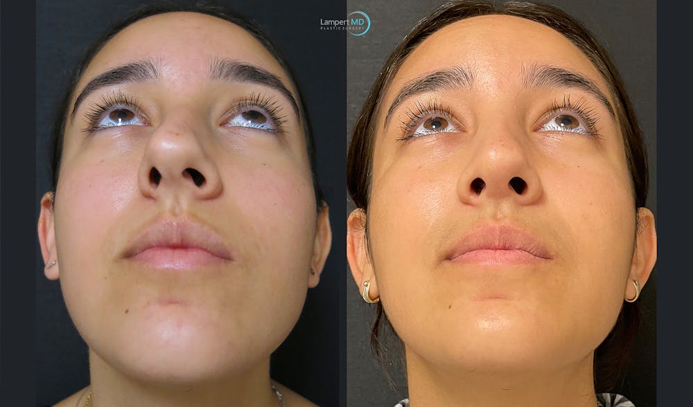 Rhinoplasty Before & After Gallery - Patient 123815998 - Image 3
