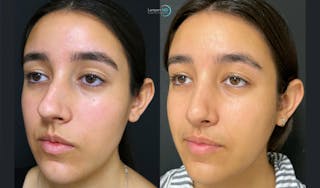 Nasal Fracture Before & After Gallery - Patient 144711756 - Image 4