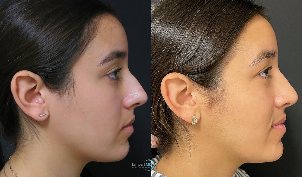 Rhinoplasty Before & After Gallery - Patient 123815998 - Image 5