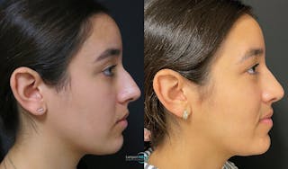 Rhinoplasty Before & After Gallery - Patient 123815998 - Image 5