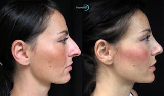 Rhinoplasty Before & After Gallery - Patient 123816065 - Image 1