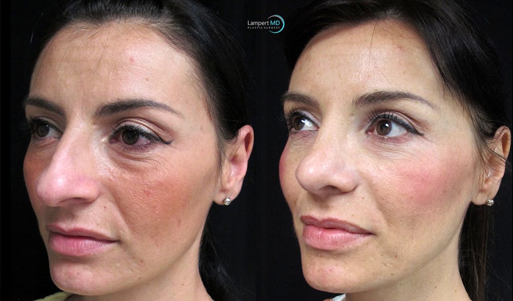 Rhinoplasty Before & After Gallery - Patient 123816065 - Image 2