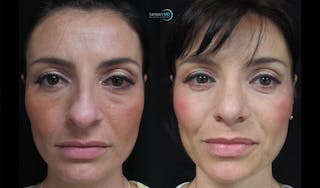 Rhinoplasty Before & After Gallery - Patient 123816065 - Image 3