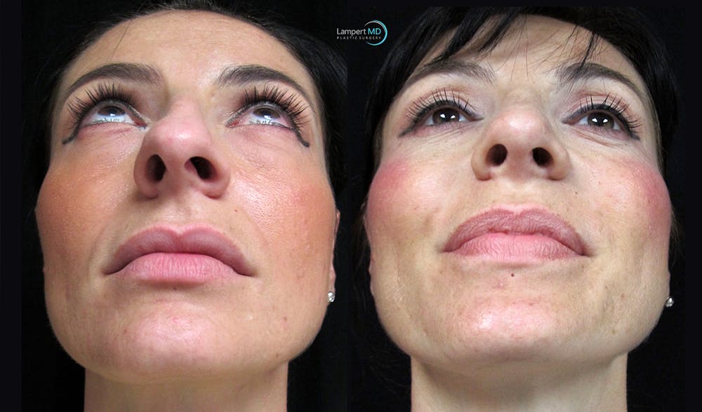 Rhinoplasty Before & After Gallery - Patient 123816065 - Image 4