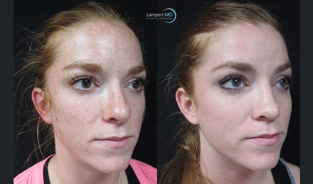 Rhinoplasty Before & After Gallery - Patient 123816075 - Image 1