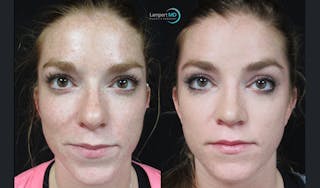 Rhinoplasty Before & After Gallery - Patient 148352808 - Image 2