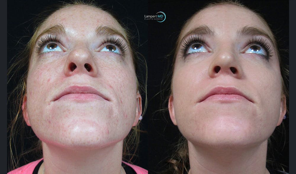 Rhinoplasty Before & After Gallery - Patient 148352808 - Image 3