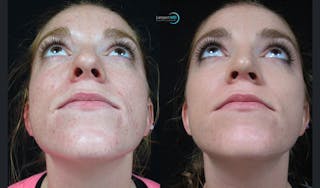 Rhinoplasty Before & After Gallery - Patient 123816075 - Image 3