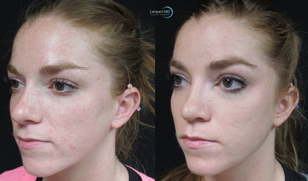 Rhinoplasty Before & After Gallery - Patient 148352808 - Image 4