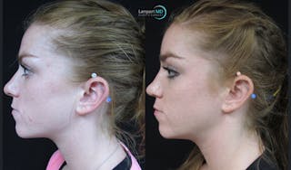 Rhinoplasty Before & After Gallery - Patient 148352808 - Image 5