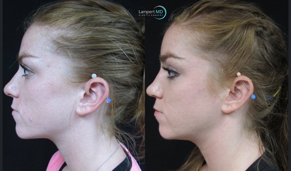 Rhinoplasty Before & After Gallery - Patient 123816075 - Image 5