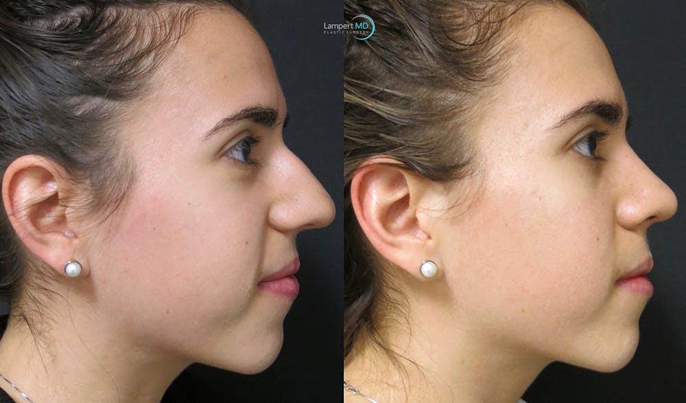 Rhinoplasty Before & After Gallery - Patient 123816076 - Image 1
