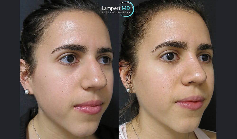 Rhinoplasty Before & After Gallery - Patient 123816076 - Image 2