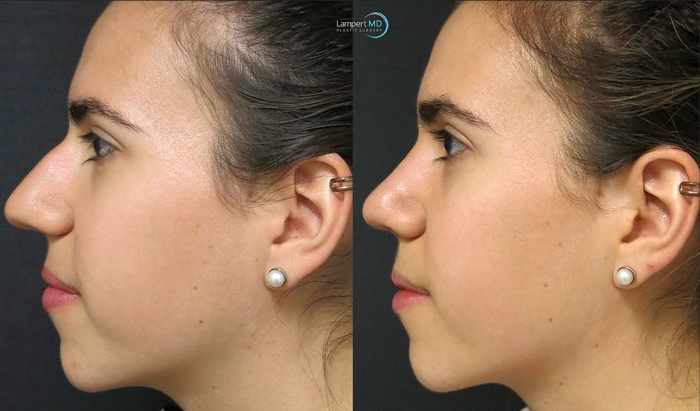 Rhinoplasty Before & After Gallery - Patient 123816076 - Image 3