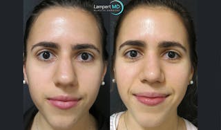 Rhinoplasty Before & After Gallery - Patient 123816076 - Image 4