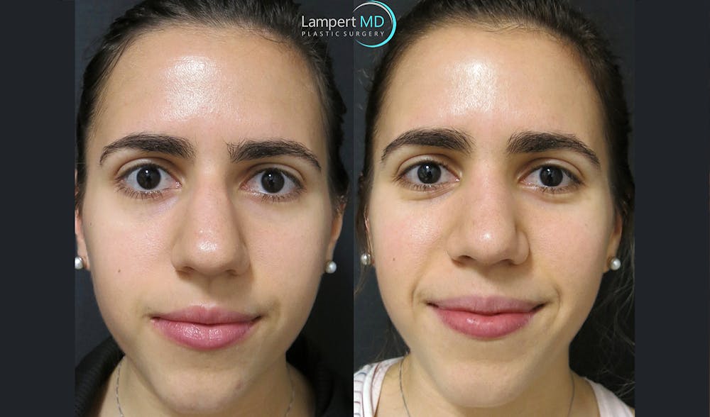 Rhinoplasty Before & After Gallery - Patient 123816076 - Image 4